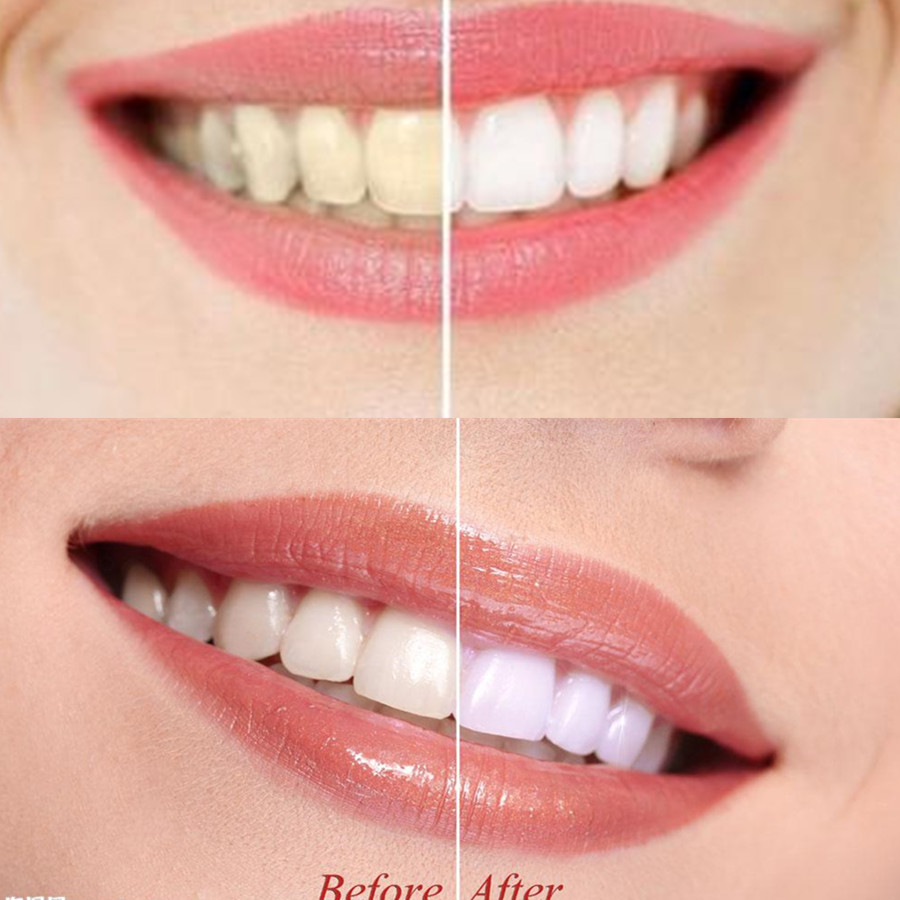 대나무 숯 치아 치아 Dentis Lab 구강 위생 관 - Teeth Whitening Quotes 리뷰 및 가격