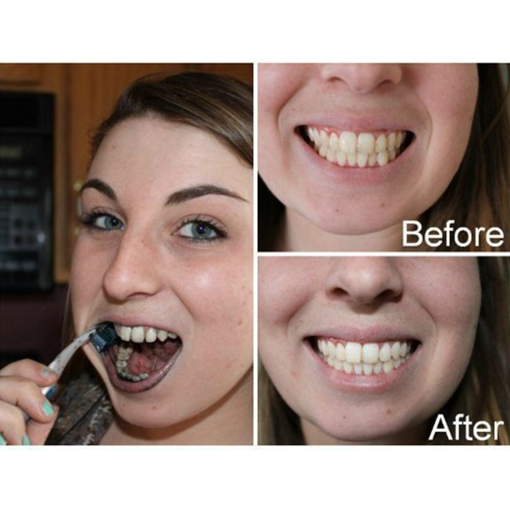 대나무 숯 치아 치아 Dentis Lab 구강 위생 관 - Teeth Whitening Quotes 리뷰 및 가격