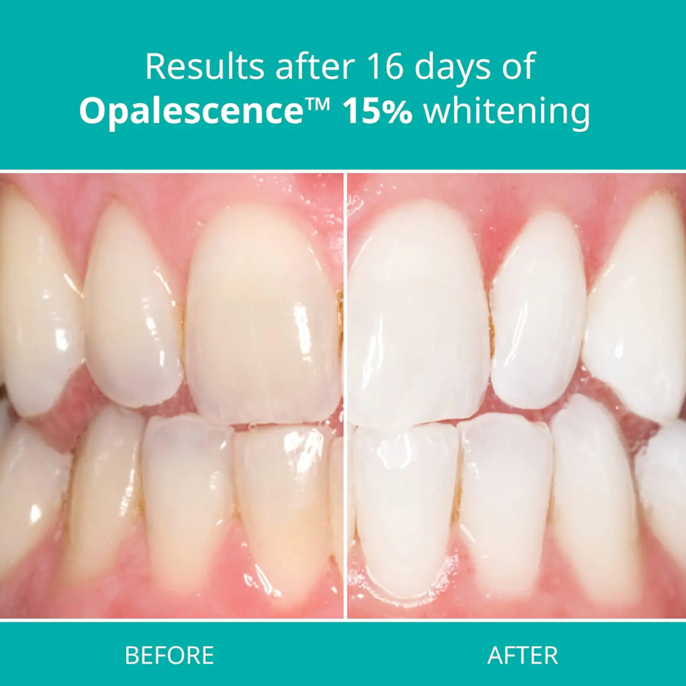 오팔레센스 프로페셔널 화이트닝 키트 15% 젤 PF 1 - Teeth Whitening Gel Refills 리뷰 및 가격