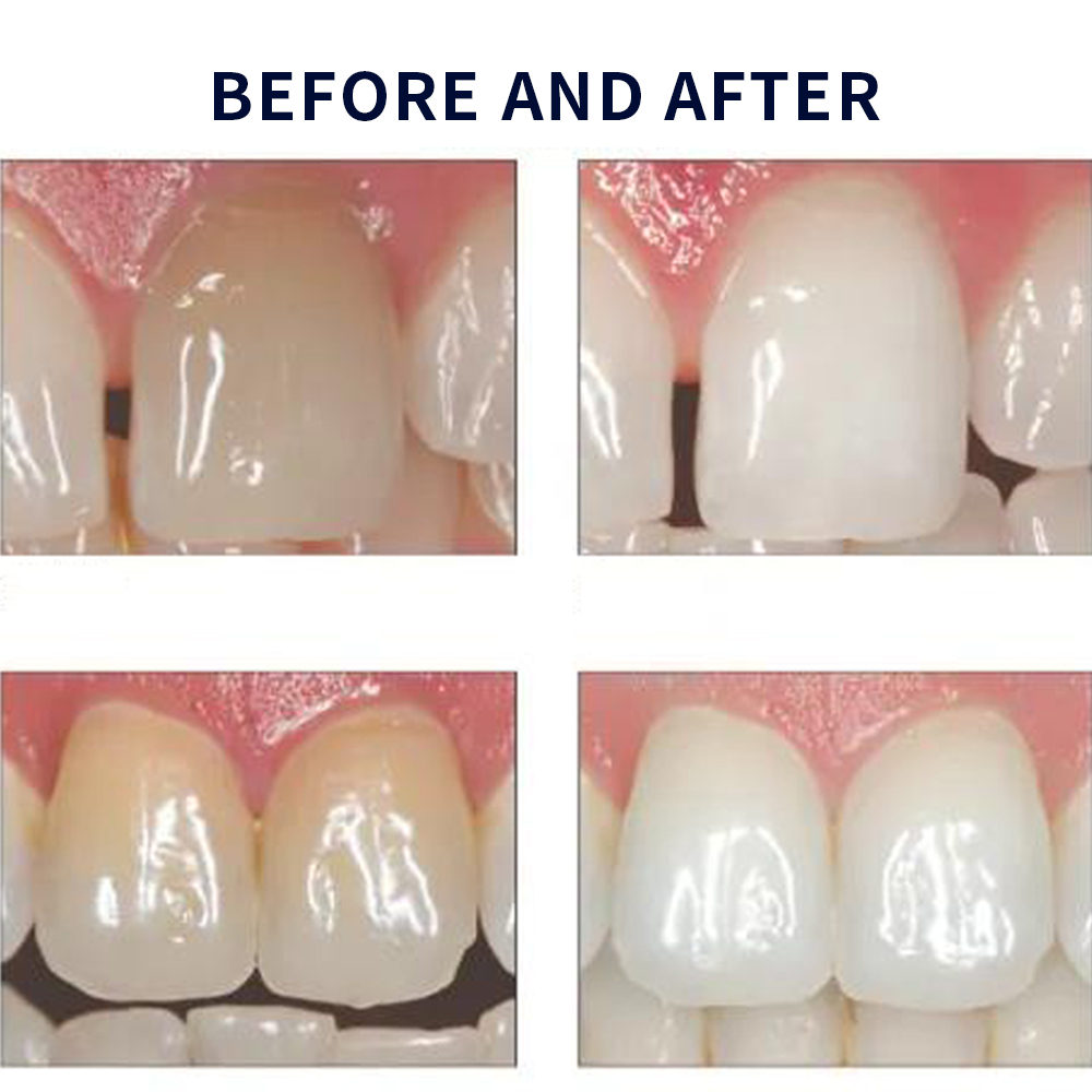유백광 미백 20% PF 20 16 젤 키트, 초강력  - Teeth Whitening In Office 리뷰 및 가격