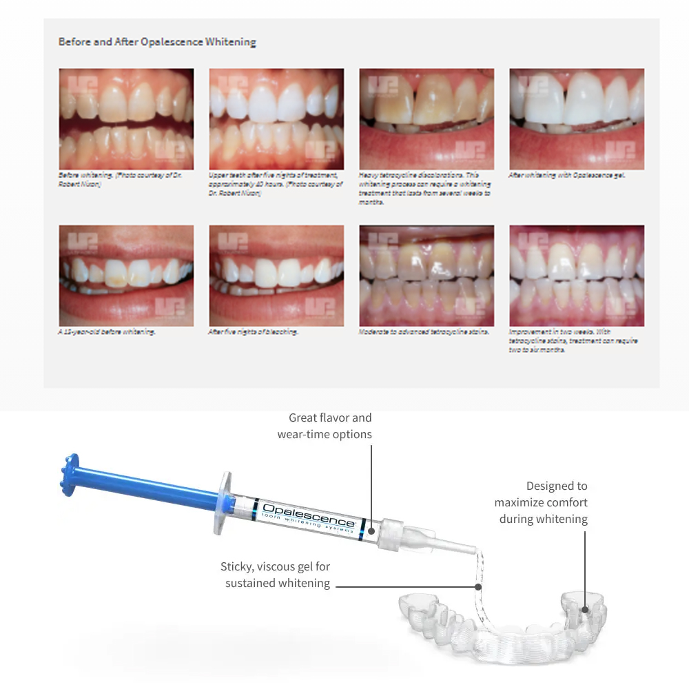유백광 미백 20% PF 20 16 젤 키트, 초강력  - Teeth Whitening In Office 리뷰 및 가격