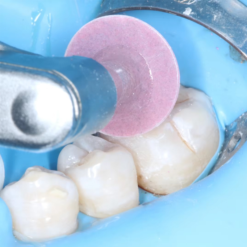 40개 치과용 연마 디스크 복합 레진 마감 연마 스템  - Teeth Whitening Home 리뷰 및 가격
