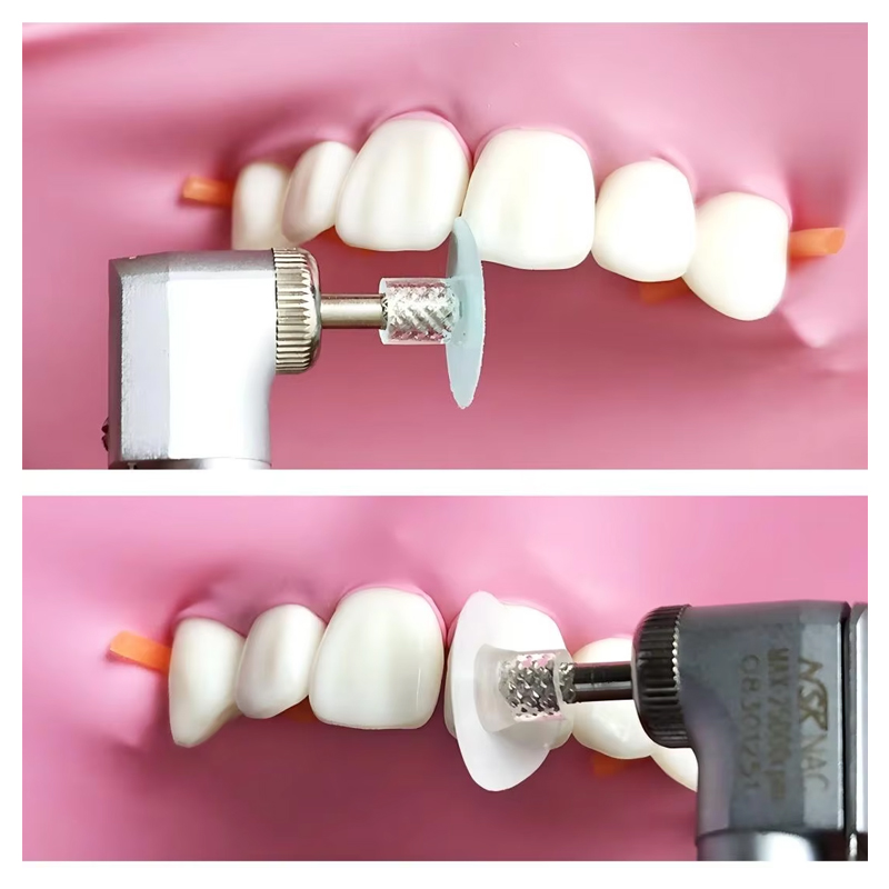 40개 치과용 연마 디스크 복합 레진 마감 연마 스템  - Teeth Whitening Home 리뷰 및 가격