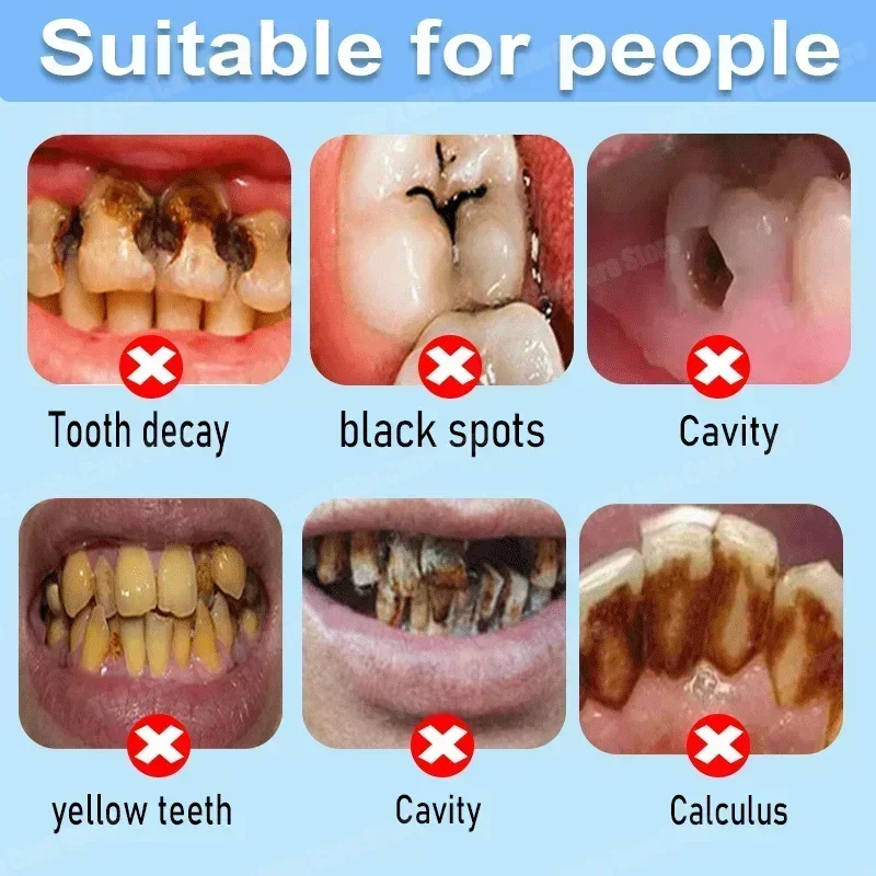 충치 방지 치약은 충치를 복구하고, 충치를 제거하며,  - Teeth Whitening Uv 리뷰 및 가격