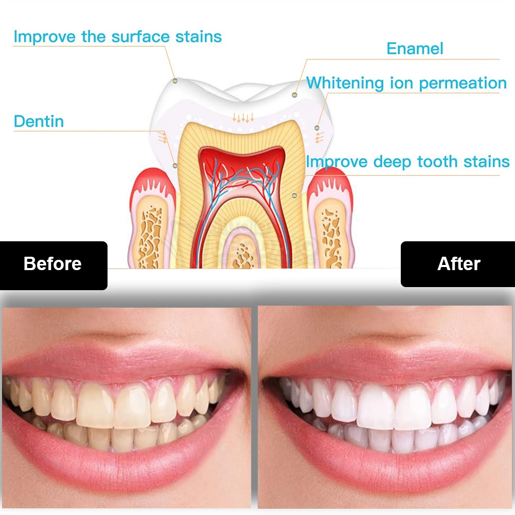 치과 치아 미백 키트 미니 16 LED 콜드 라이트 3 - Teeth Whitening Kit With Light 리뷰 및 가격