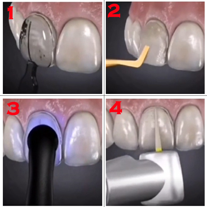 32개 치과용 베니어 몰드 키트 복합 레진 몰드 광중합 - Teeth Whitening Kit With Light 리뷰 및 가격