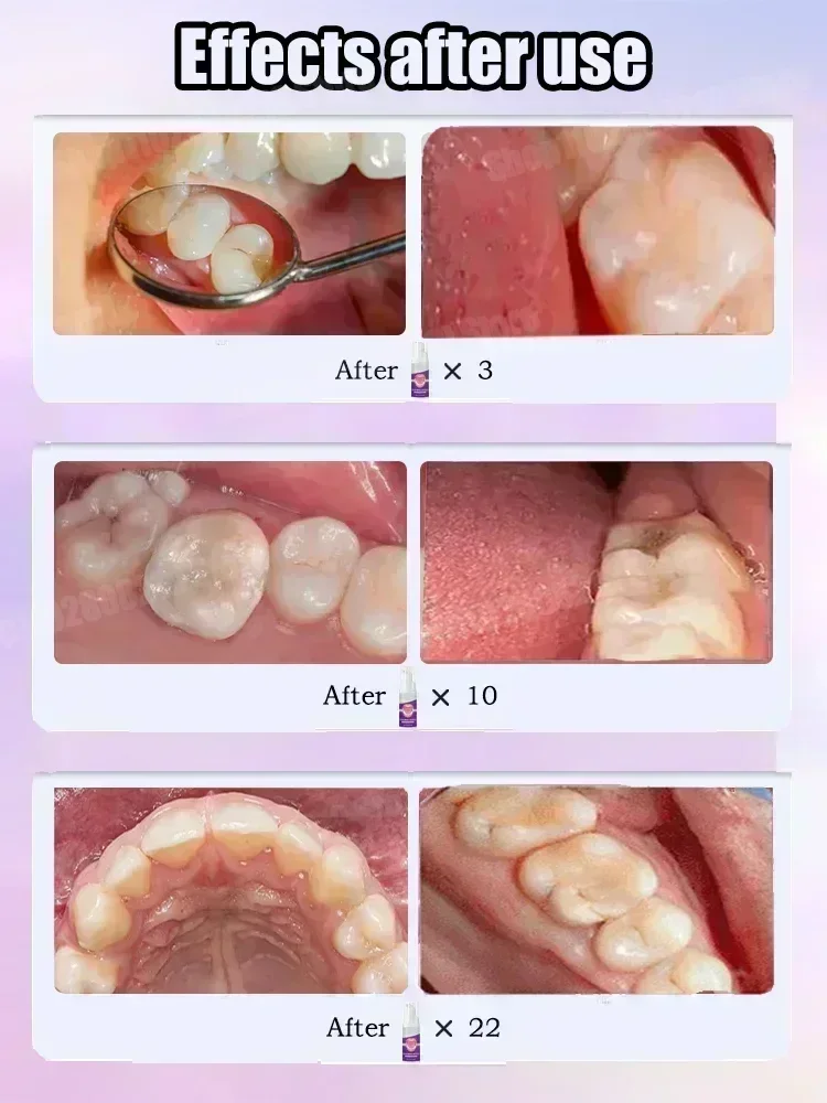 치아 청소 치약은 치아 얼룩을 제거합니다. 치아 미백  - Teeth Whitening Best 리뷰 및 가격